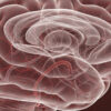 Normal Pressure Hydrocephalu
